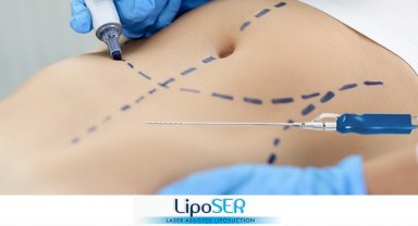 Lazer destekli Liposer ile fazla yağlardan kurtulmak mümkün