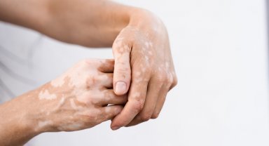 Leke tedavisinde en önemli adım güneşten korunmak